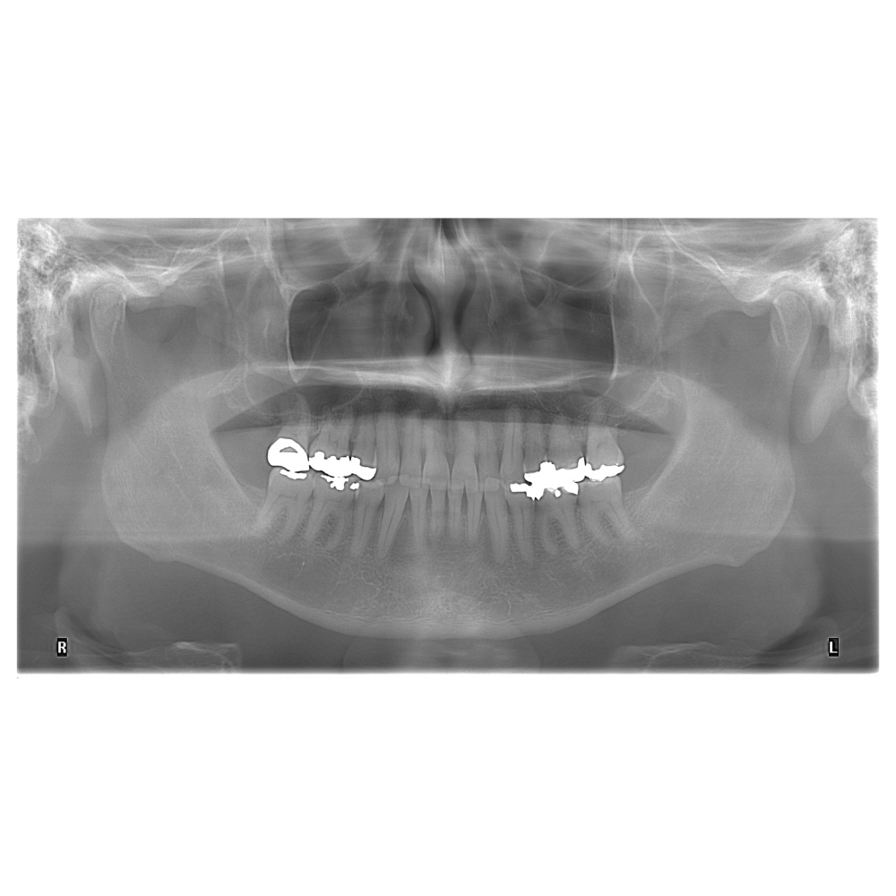 Pano en máxima intercuspidación